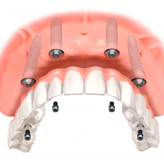 Implantologie<br>et chirurgie